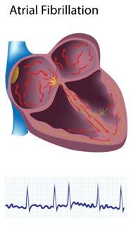 MAZE: Building a Path in the Heart to Fix Atrial Fibrillation - McLeod ...