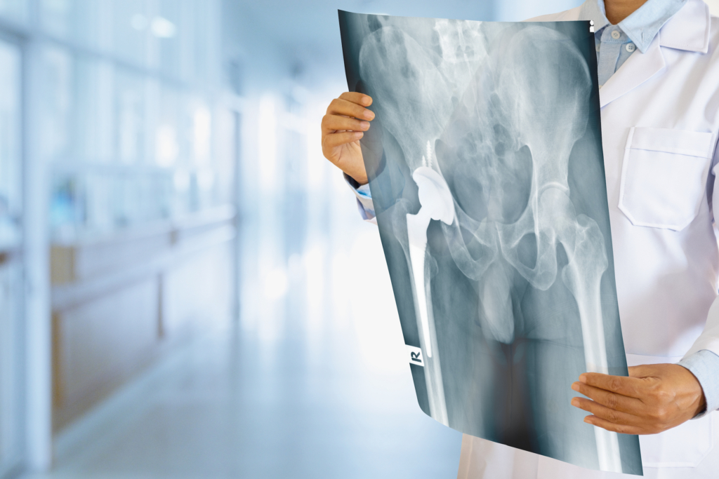 How Do Traditional And Minimally Invasive Hip Replacements Differ? - Aditi  Corporation