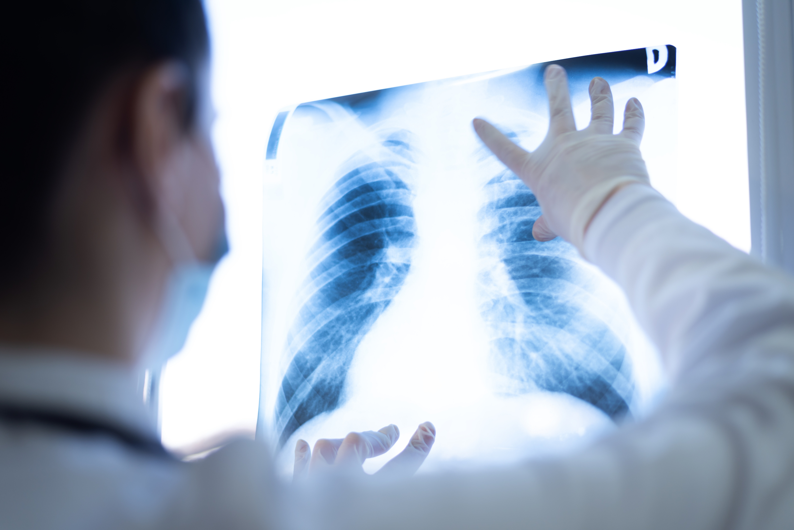 Why Lung Cancer Screenings Save Lives - McLeod Health