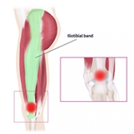 Iliotibial Band Syndrome: A Problem for Runners and Cyclists - McLeod Health